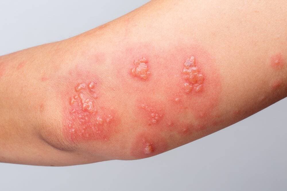 Dấu hiệu nhận biết và cách phòng tránh sự tấn công của kiến ba khoang