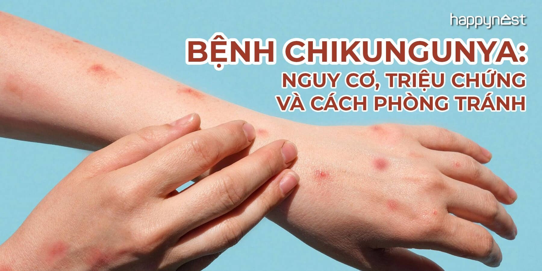 Bệnh Chikungunya: Nguy cơ, triệu chứng và cách phòng tránh để bảo vệ sức khỏe